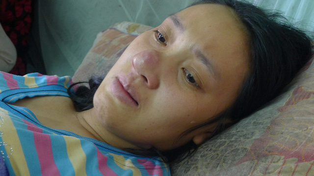 Bị chảy máu ồ ạt sau sinh con được 4 tháng, lên trên bệnh viên khám Hương được các bác sĩ cho biết bị ung thư mũi đã di căn phổi.